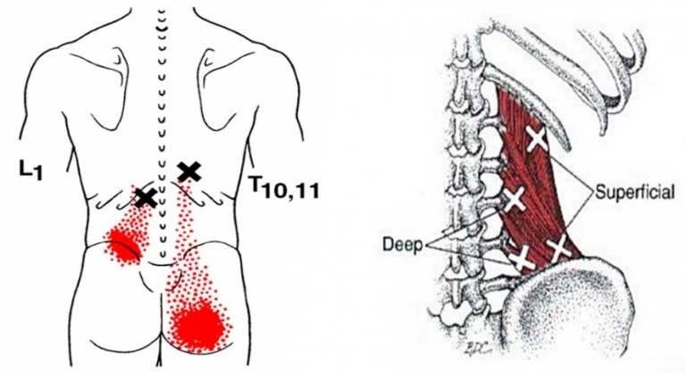 What Is A Trigger Point?